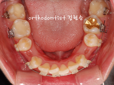 강남 돌출 (토끼 치아) 관련 이미지 21