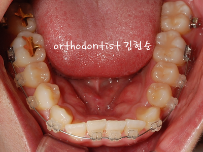 반대교합 관련 이미지 15