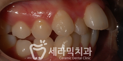 치아교정 전후 스마일라인 변화!(돌출입,토끼앞니, 중심선 비대칭 동시 교정) 관련 이미지 7