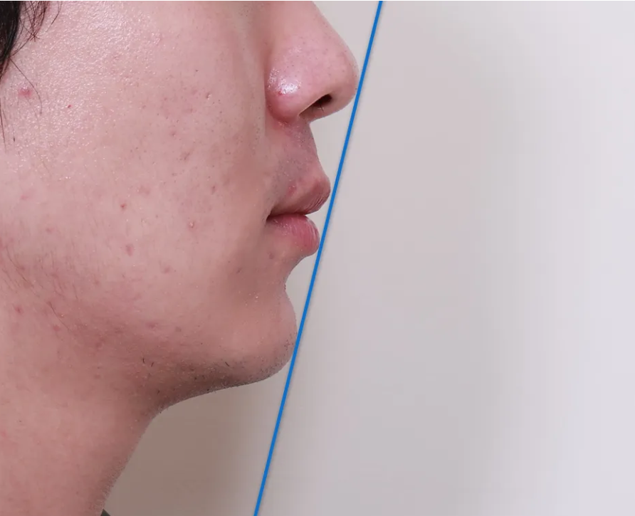 결손치를 임플란트 없이 교정으로 치료한 사례 관련 이미지 11