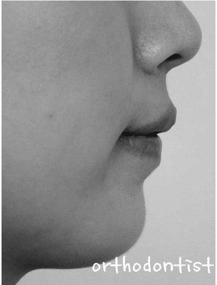 강남 과개 교합 관련 이미지 5