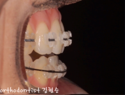 강남교정치과 관련 이미지 16