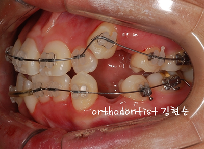 강남 덧니 관련 이미지 18