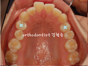 강남 돌출입 교정 관련 이미지 18
