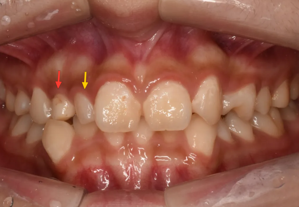 왜소치, 결손치가 동시에 있었던 환자의 앞니 심미보철 관련 이미지 3