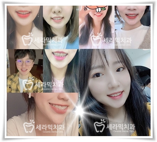 앞니 돌출, 개방교합으로 치아교정을 시작했는데, 작았던 아래턱이 커졌어요! 관련 이미지 19