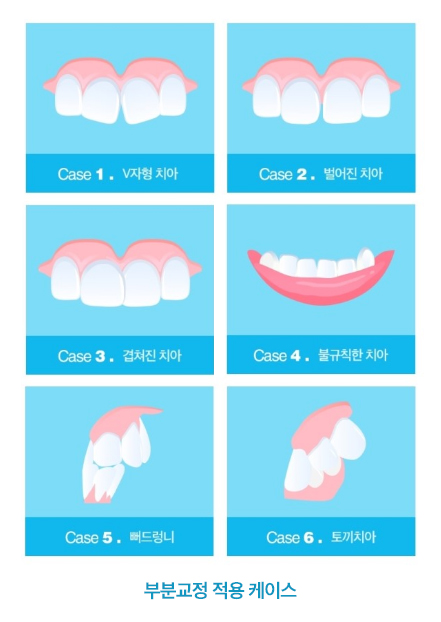 [강남치아교정] 치아교정기간 줄이는 방법 관련 이미지 5