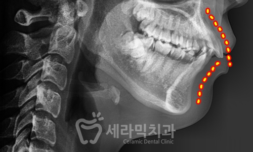 Before and After Orthodontic Treatment for Protruding Mouth and Deep Bite: A Calmer, More Sophisticated Transformation! image 4