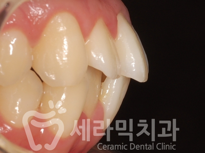 치아교정 전후 확연한 인상 변화! 관련 이미지 7