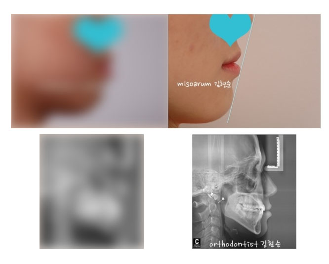 주걱턱교정 수술없이 해결? 관련 이미지 9