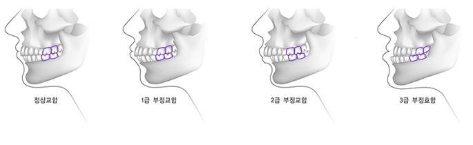 [세라믹치과 치아교정 칼럼] 아름다운 미소와 건강한 미소는 별개가 아닙니다. 관련 이미지 2