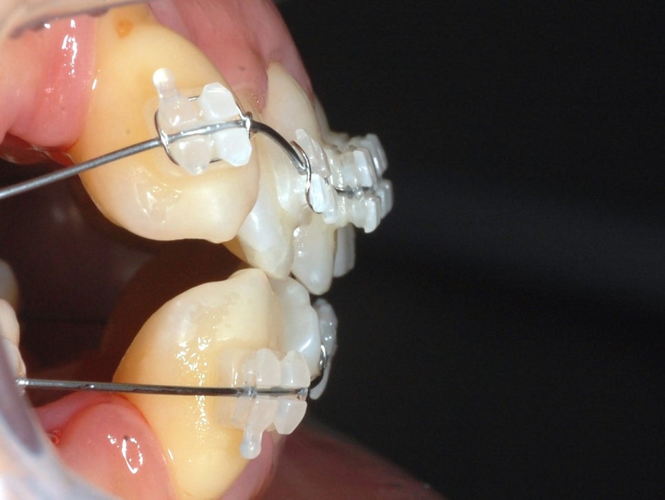 학동역치과 세라믹교정 특징은? 관련 이미지 9