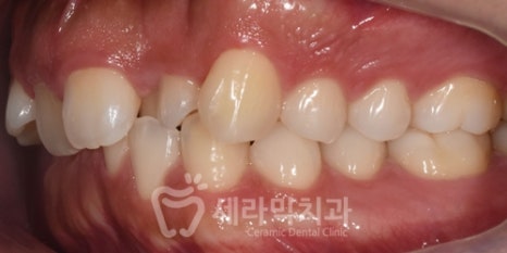 A Case of Overretained Teeth and Deep Bite Orthodontics That Helped the Patient Smile Confidently Before and After image 6