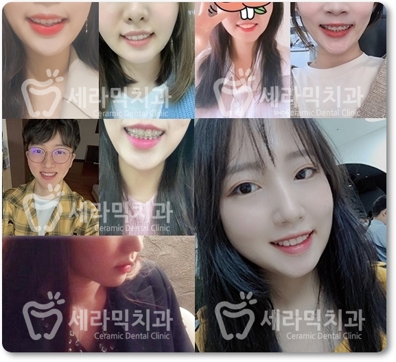 치아교정만으로 세마리 토끼를 한번에! 돌출입, 무턱, 치열불규칙 치아교정전후 관련 이미지 14