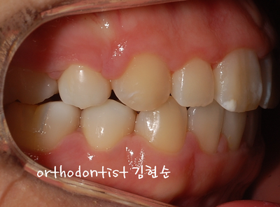 강남 돌출 관련 이미지 30