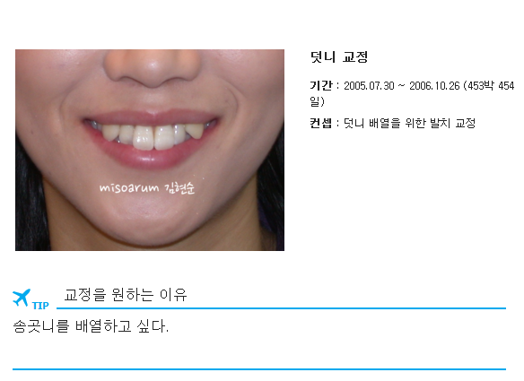 세라믹교정 덧니교정 관련 이미지 3