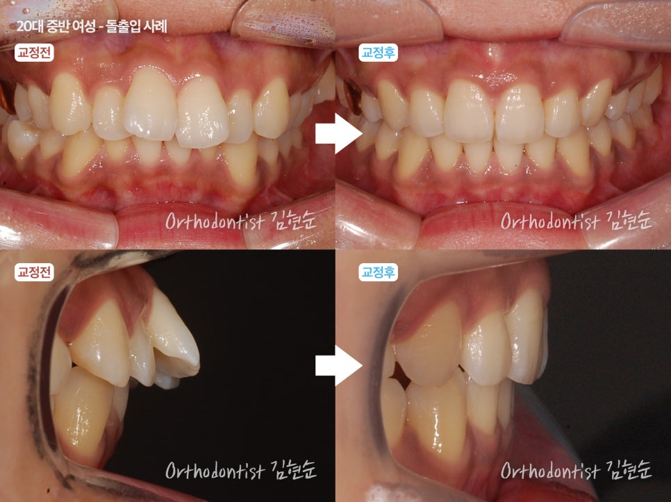 학동역치과 치아교정은 여기서 !! 관련 이미지 12