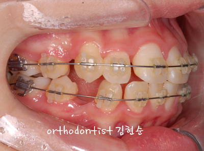 강남 돌출 (토끼 치아) 관련 이미지 22