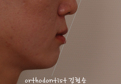 반대교합 관련 이미지 9