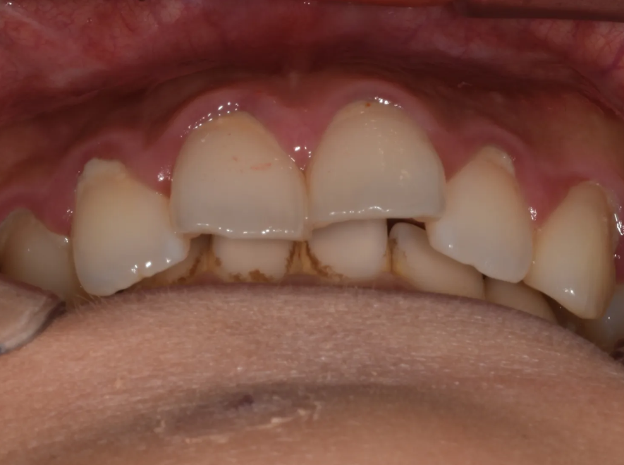 과개교합 교정: 비수술로 치료한 토끼 이빨 이야기 관련 이미지 3