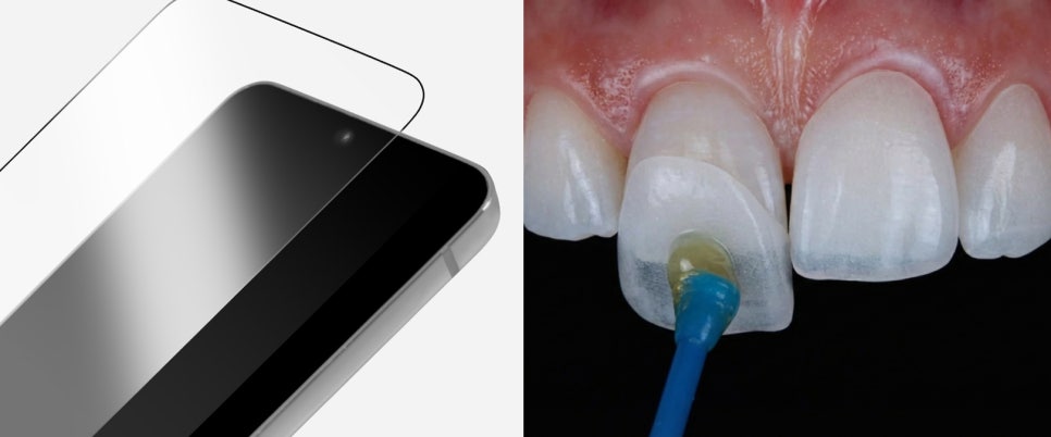 논현역 치과, 치아를 갈아내지 않는 무삭제 라미네이트 관련 이미지 2