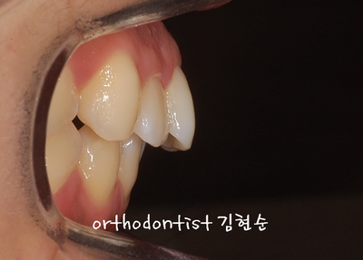 강남 돌출 관련 이미지 10