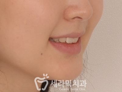 토끼이빨 돌출입 치아교정 전후 표정변화! 관련 이미지 17
