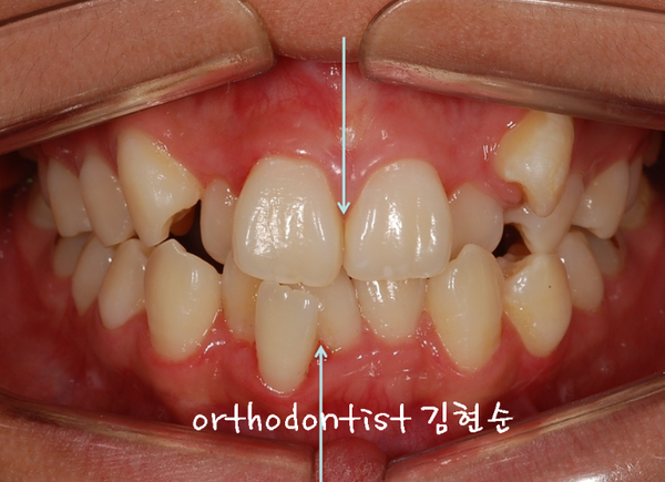 강남 덧니 관련 이미지 2