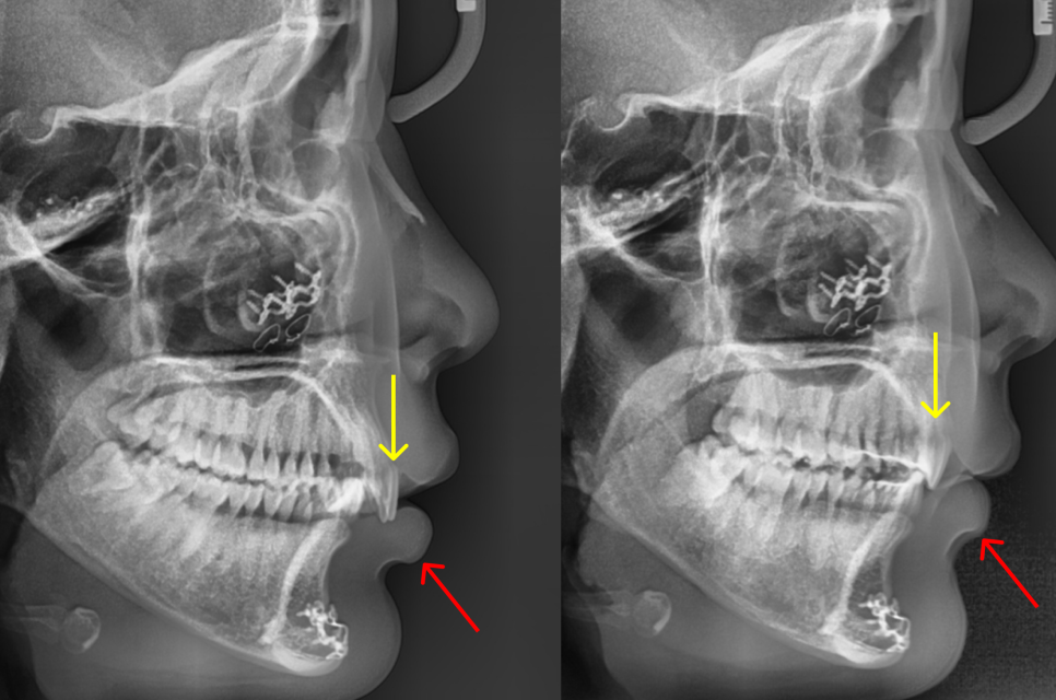 과개교합 교정: 비수술로 치료한 토끼 이빨 이야기 관련 이미지 14