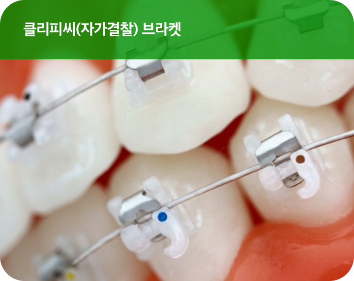 강남치아교정 브라켓비교분석 관련 이미지 8