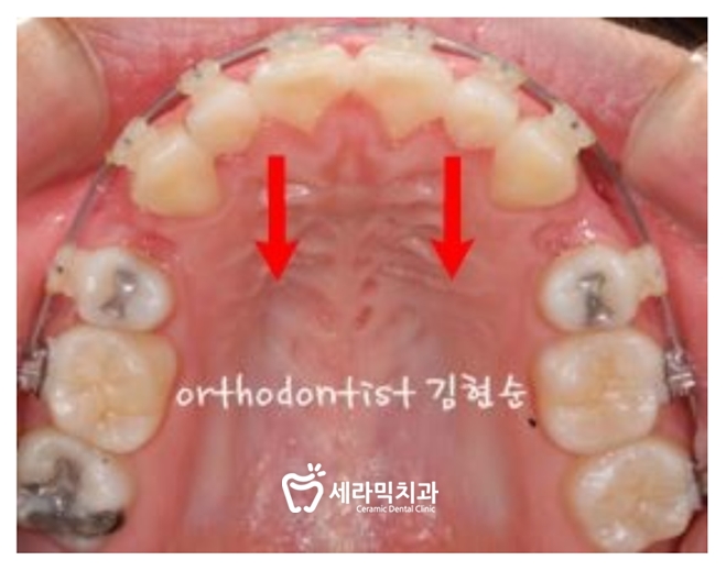 돌출입 교정으로 외모변화를 확인 관련 이미지 7
