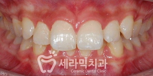 청소년교정 10대교정 딥바이트 과개교합 치아교정전후 관련 이미지 9