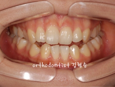 강남교정치과 관련 이미지 6