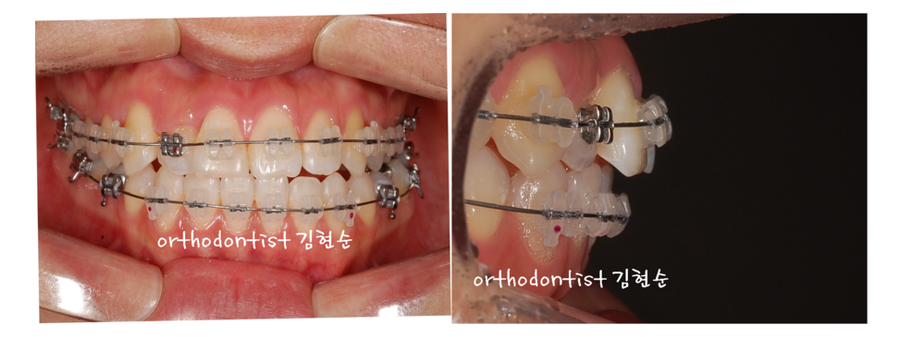 안면비대칭 교정, 치아교정만으로 간단히 해결하기 관련 이미지 9