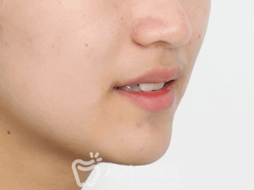 교정 전 어색한 웃음이 치아교정전후 함박웃음으로 변하게 된 사례 관련 이미지 3
