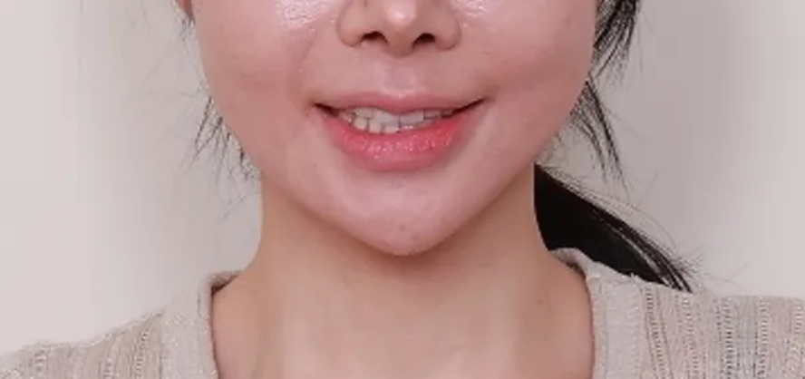 A Case of Improving the Smile Line Along with Replacing a Front Tooth Crown image 2
