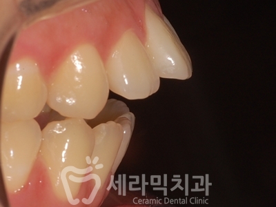 돌출입과 개방교합 치아교정 치료전후 관련 이미지 10