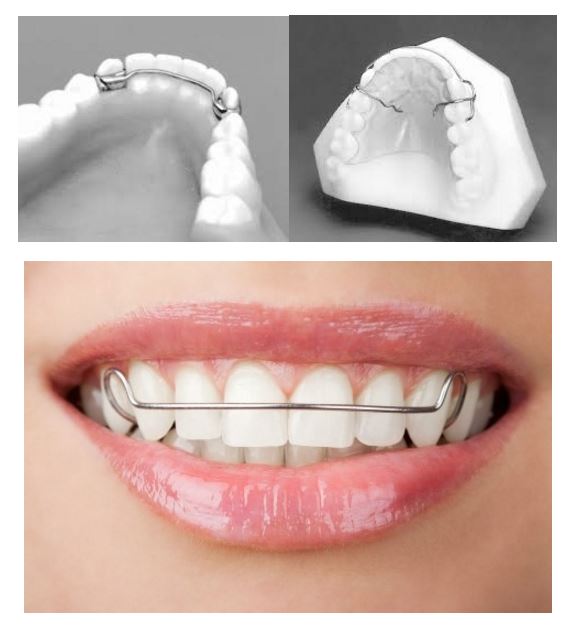 세라믹치과 교정유지장치 종류 관련 이미지 3