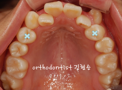 강남 덧니 관련 이미지 10