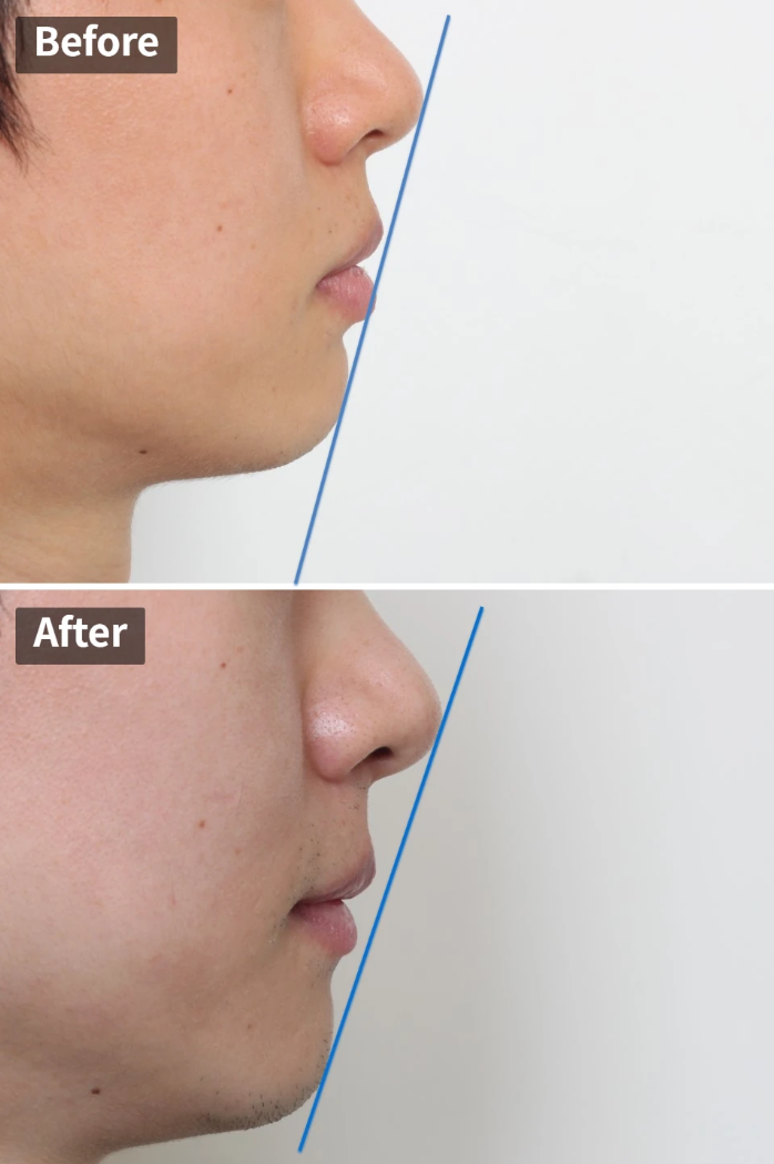 돌출입 재교정, 그것도 세 번째. 관련 이미지 1