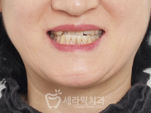 40대에 이어 50대 치아교정 전후사례 증가 추세 관련 이미지 17