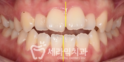 혀내밀기 습관과 개방교합, 오픈바이트(Open bite) 치아교정전후 보기 관련 이미지 6