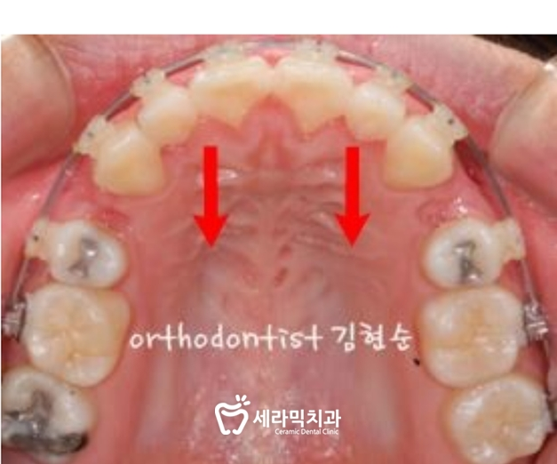 학동역 돌출입교정 세라믹치과 관련 이미지 8