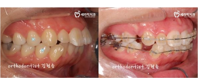 학동역 돌출입교정 세라믹치과 관련 이미지 9