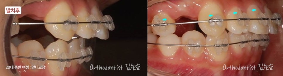 강남치아교정 브라켓비교분석 관련 이미지 20