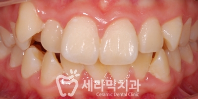 토끼이빨 돌출입 치아교정 전후 표정변화! 관련 이미지 4
