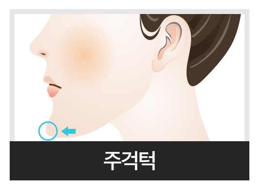 주걱턱교정 수술없이 해결? 관련 이미지 3
