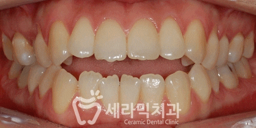 돌출입과 개방교합, 치아교정전후 자신감 UP! 치아건강 UP! 관련 이미지 6