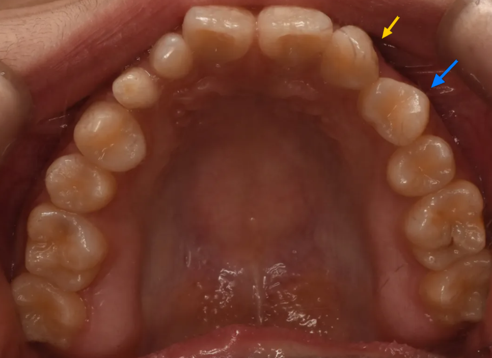 왜소치, 결손치가 동시에 있었던 환자의 앞니 심미보철 관련 이미지 7