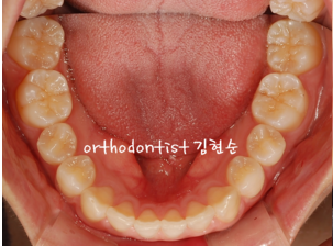 강남 돌출입 교정 관련 이미지 21